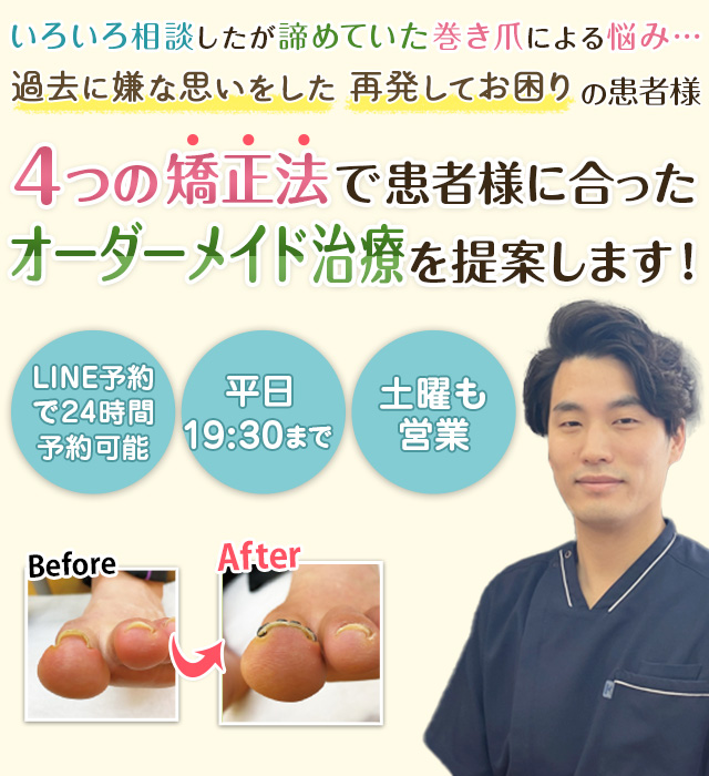 習志野市の巻き爪矯正FLAT